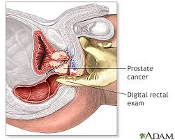 Comparison of digital rectal examination and serum prostate specific antigen (psa) in the early detection of prostate cancer: Digital Rectal Exam Information Mount Sinai New York