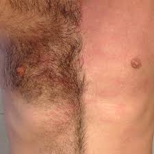 Causes of excessive body hair in males. Chest Hair Removal For Men