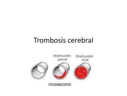 Symptoms may include headache, abnormal vision. Trombosis Cerebral