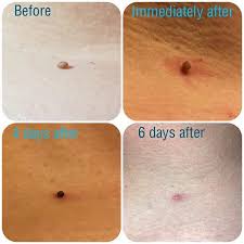 A doctor should be consulted following a skin tag removal if there is an infection or the tag returns in the same spot. Skin Tag Removal With Cryotherapy Prices Start From 30 Contact The Salon To Book Your Free Consultation Thesalon Guin Skin Tag Removal Cryotherapy Skin Tag