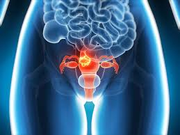 Uterine cancer is a cancer which develops in the womb (uterus). Womb Cancer Is On The Rise Experts Warn The Signs You Need To Know