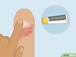 Image result for Balanitis