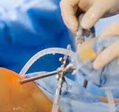 Tipos de cirurgia de quadril: conheça as principais opções