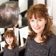 Androgenetic alopecia is related to hormones called androgens, which are essential to normal male sexual development and also regulate hair growth. Clients Hair Loss Photos Showing A Wide Range Of Conditions Female Pattern Hair Loss Female Pattern Baldness Hair Loss Women