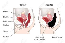 Pin On Constipation Parent Info
