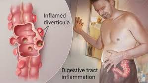 Image result for Diverticulitis