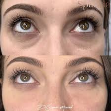 Under eyes Filler ✨, عطونا رأيكن بكومنت♥️, ., ., ‎ 🛎 كومنت بنقطة لمعرفة  أنواع الفيلر والأسعار, ., ., ‎📍العنوان : المالكي مقابل مدرسة ساطع الحصري ,  @sparkle.clinic1 🌏, ., ., #dr.samer_mourad ...