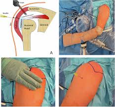 Image result for Subacromial Space Injection