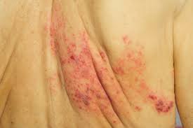 We did not find results for: How Shingles Affects The Entire Body