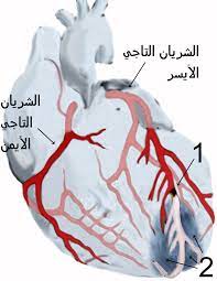 Within this group the rate of referral to cabg was significantly higher. Ù†ÙˆØ¨Ø© Ù‚Ù„Ø¨ÙŠØ© ÙˆÙŠÙƒÙŠØ¨ÙŠØ¯ÙŠØ§