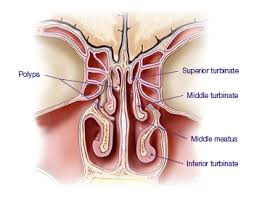 It is the entry point for inspired air and the first of a series of structures which form the respiratory. About Nasal Polyps Xhance Fluticasone Propionate