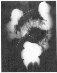 Phase of acute appendicitis nb! Diverticular Disease In The Elderly Gastroenterology Clinics