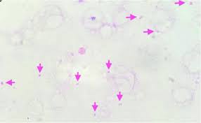 A diplococcus (plural diplococci) is a round bacterium (a coccus) that typically occurs in the form of two joined cells. Gram Stain Of Blood Cultures Demonstrating Gram Negative Diplococci In Download Scientific Diagram