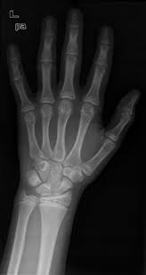 Bone Age Assessment Radiology Reference Article Radiopaedia Org