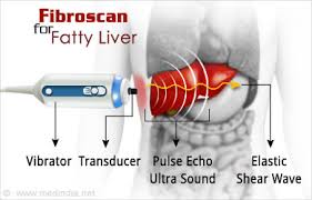 Fibroscan For Fatty Liver Cirrhosis And Fibrosis Causes