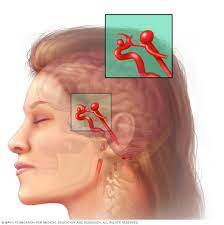 Brain Aneurysm - Symptoms And Causes - Mayo Clinic