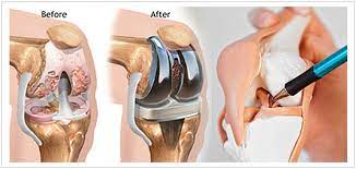 Best Orthopedic Doctor Jaipur No 1 Knee Joint Replacement Surgeon Muscle Specialist Doctor Bone Specialist Doctor Jaipur Udaipur Rajasthan Kishangarh Beawar Kota Chittorgarh Ajmer Orthopedic Specialist Jaipur Best Orthopaedic Doctors