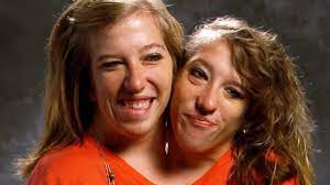 They do not share a heart, stomach, spins, lungs or spinal cord. Abby And Brittany Conjoined Twins Now Have They Been Separated Are They Married