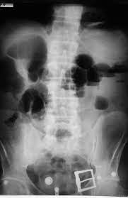 Abdominal Film In An Upright Position Showing Air Filled Small Bowel Download Scientific Diagram