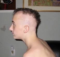 We recently asked bored pandas around the world to share before and after haircut pics of their extreme makeovers, and we were pleasantly surprised! I Do Not Have Alopecia Alopecia Has Me Aug 4 2018 By Skylar Rea Medium