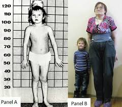 Image result for Homocystinuria