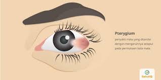 Solusi untuk mencegah dan meringankan penglihatan yang kabur kamu harus berhenti. Pterygium Tanda Dan Gejala Penyebab Cara Mengobati Cara Mencegah