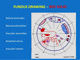 Looking Deep Into Retina Indirect Ophthalmoscopy And