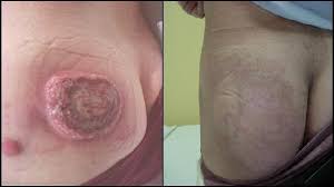 These tumors originate from sensory merkel cells. Radiotherapy Is Associated With Significant Improvement In Local And Regional Control In Merkel Cell Carcinoma Radiation Oncology Full Text