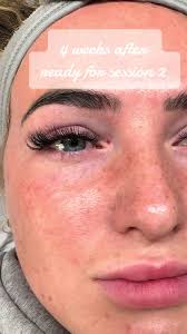LUMI EYES >>> tired eyes ✨ Now taking SUMMER SALE bookings via instagram  too check us out💅🏽 #foryoupage #foryou #greenwich #thamesmead  #skinboosters #skinboosterslondon #aesthetics #estheticianlife ...