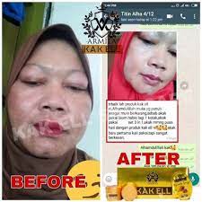 Ramai yang mengadu kulit breakout kerana menggunakan produk tertentu. Skincare Kak Ell Original Hq By Merry Kosmetik Shopee Malaysia
