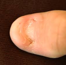 Nail Patella Syndrome Wikipedia