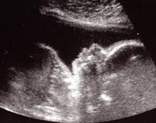 Intake of fatty, spicy, fried and smoked food must be excluded, or at least must be reduced to minimum as well. You Are 25 Weeks And 1 Day Pregnant Familyeducation
