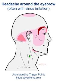 Stiff Neck Archives Integrative Works Trigger Points Headache Natural Headache Remedies