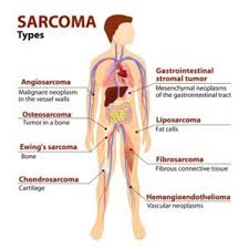 Bengkak dan kelembutan berhampiran kawasan terjejas. Apa Itu Sarcoma Cancer Resource Education Center Care