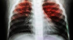 Check spelling or type a new query. Asbestosis Gejala Faktor Risikoasbestosis Herbaltama Persada