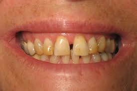 Coffee Stained Teeth Stained Teeth Teeth Stain