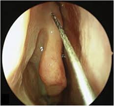 Image result for Sinusitis Prediction Rule