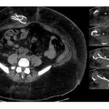 Second Episode Of Vp Shunt Migration Into The Abdominal Wall Download Scientific Diagram