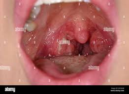Image result for Tonsillitis