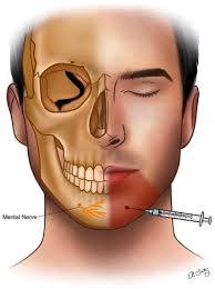 Image result for Forehead Regional Block