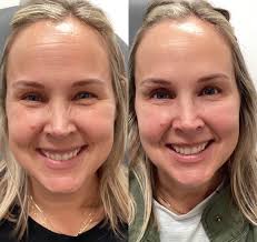 Maggie Cadavero — Botox, Filler, Fat Removal │ Aluma Medical Aesthetics