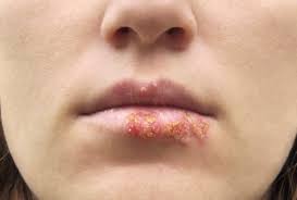 Para el tratamiento del herpes zoster se usan diferentes tipos de medicamentos. Was Ist Herpes Und Was Kann Ich Gegen Herpesblaschen Unternehmen Herpes Guru