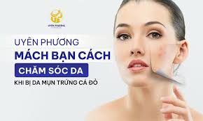 UYÊN PHƯƠNG MÁCH BẠN CÁCH CHĂM SÓC DA BỊ DA MỤN TRỨNG CÁ ĐỎ