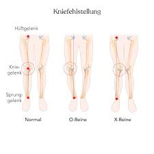 Der einzige zielmuskel beim bein training an diesem gerät ist die innere oberschenkelmuskulatur. X Beine Bei Kindern Und Erwachsenen Behandeln Liebscher Bracht