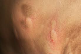 Image result for Spider Bite