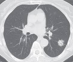 Changes in vesicular respirationpleural friction noise. Neoplasms Of The Lung Radiology Key