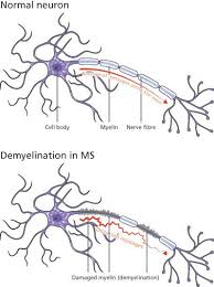 But which specific symptoms someone with ms gets, and in what order, will vary depending on. Multiple Sclerosis Great Ormond Street Hospital