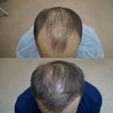 Пересадка волос - Petah Clinic