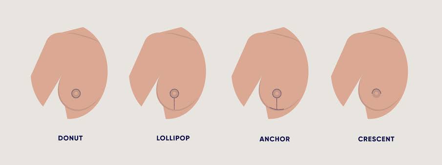 Common Breast Lift Incision Patterns, AI generated