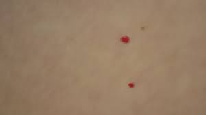 Maybe you would like to learn more about one of these? Dust Mites Bites Picture Of Hotel Baia Cascais Tripadvisor